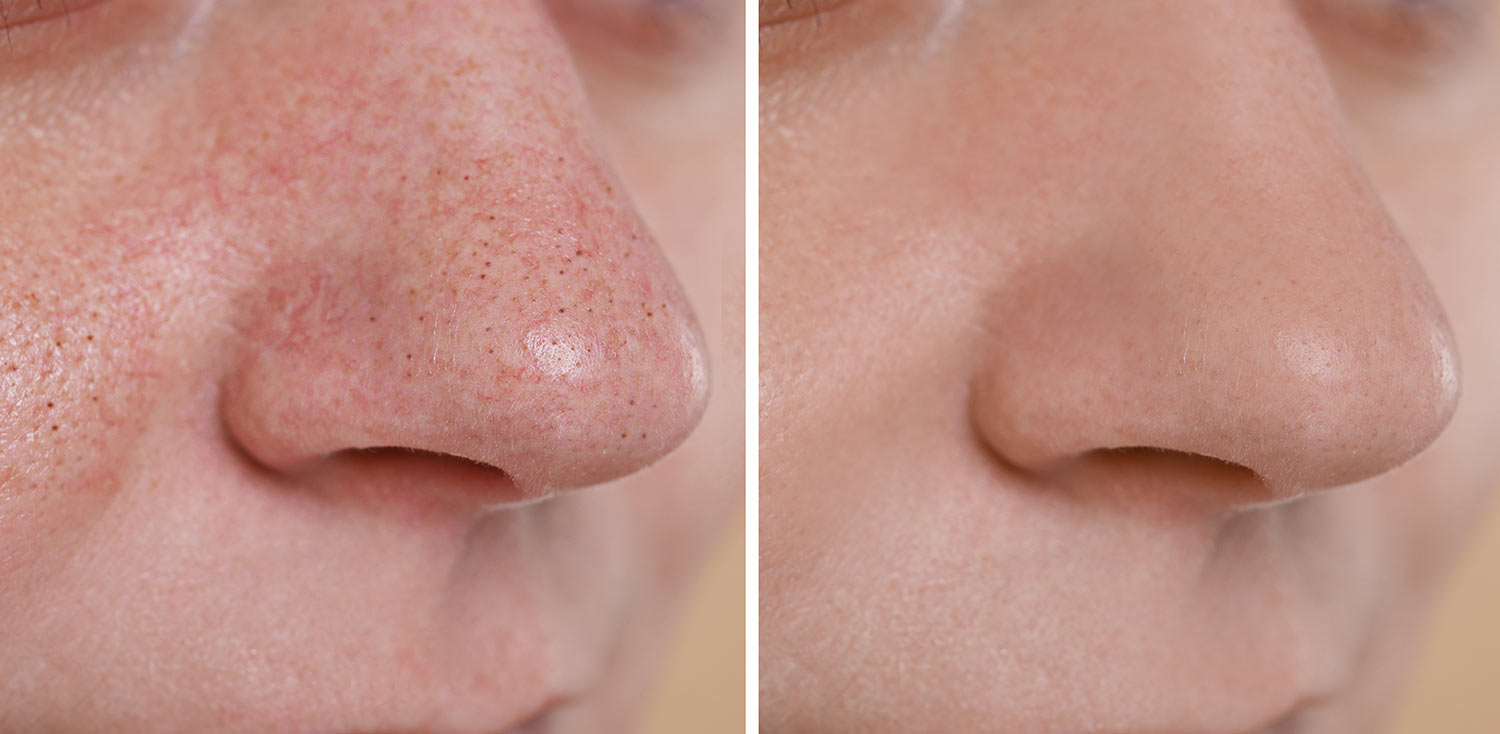 Vorher-Nachher Microneedling Radeberg