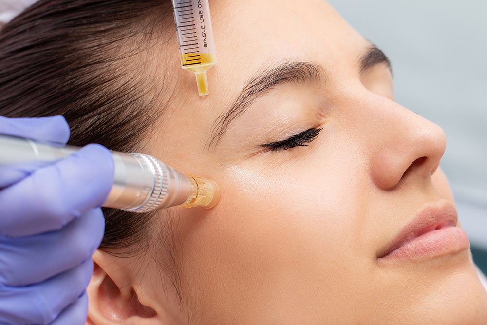 Microneedling Radeberg